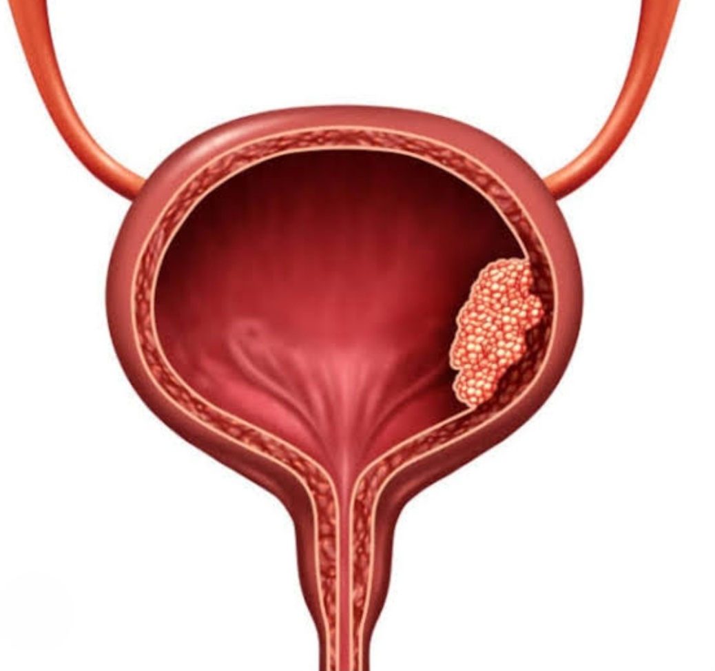 bladder cancer