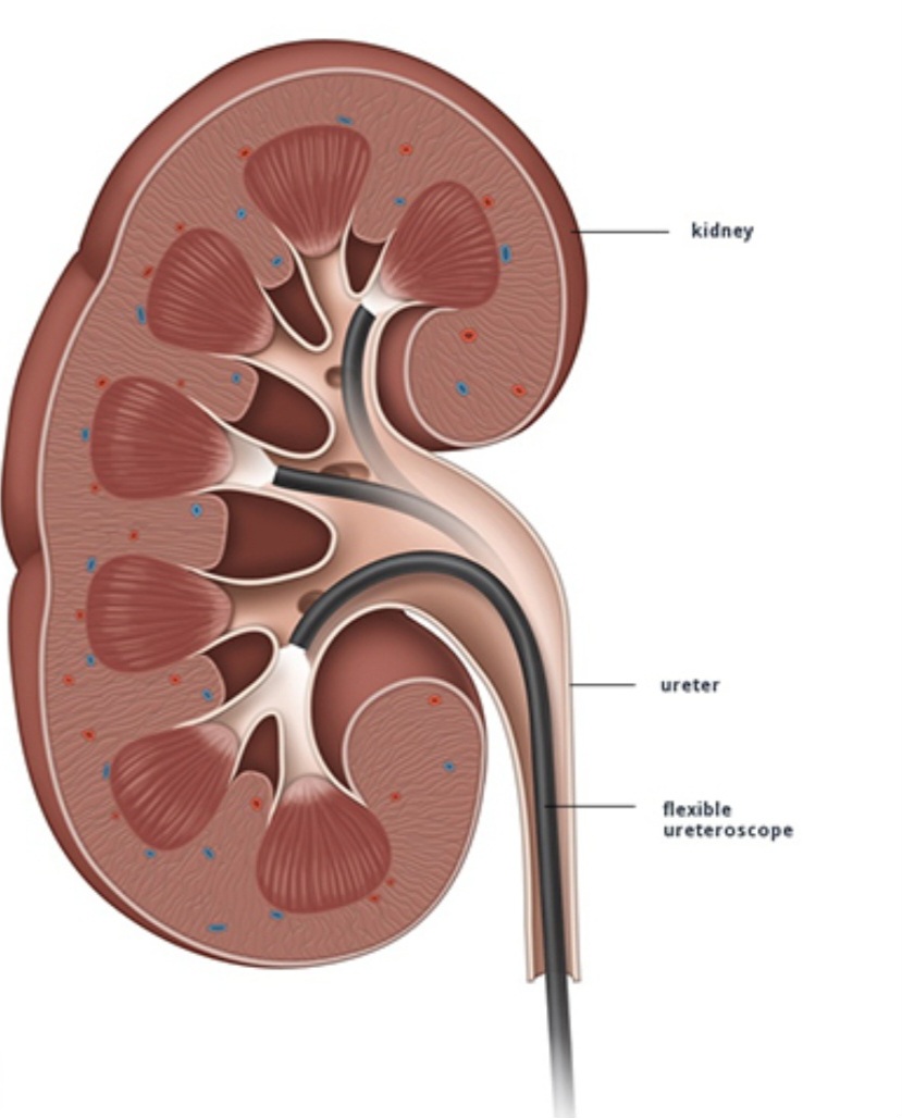 kidney urs