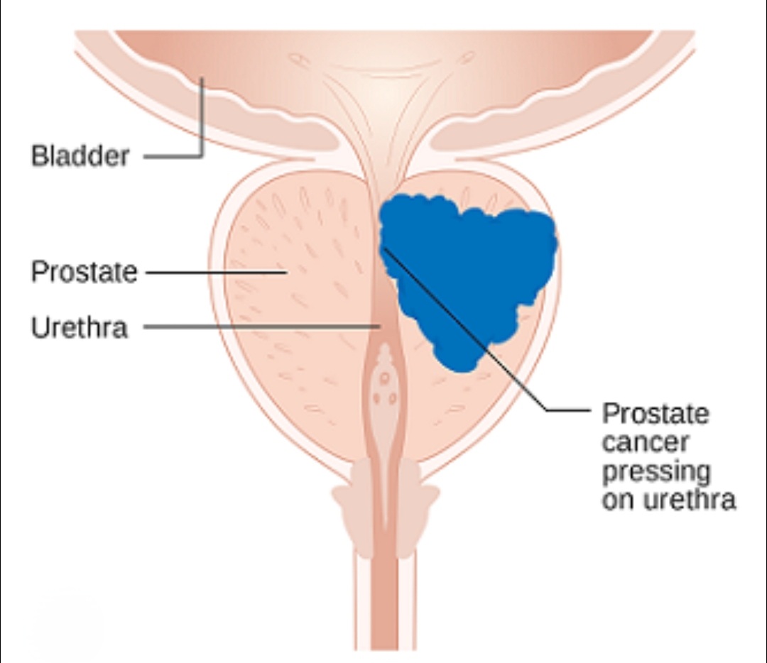 prostate cancer