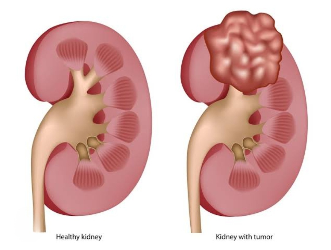 renal cancer